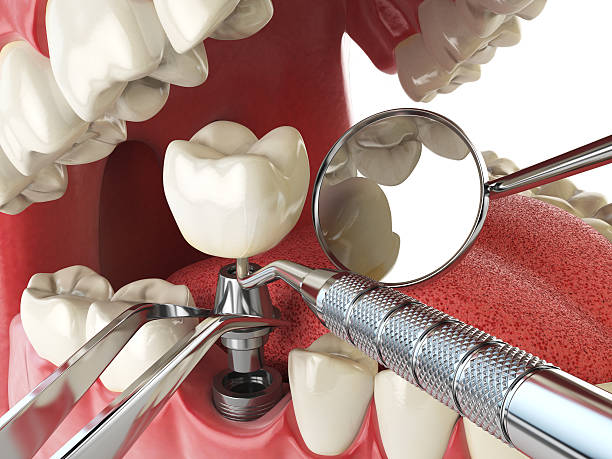 Best Emergency Root Canal Therapy in Harrison, OH