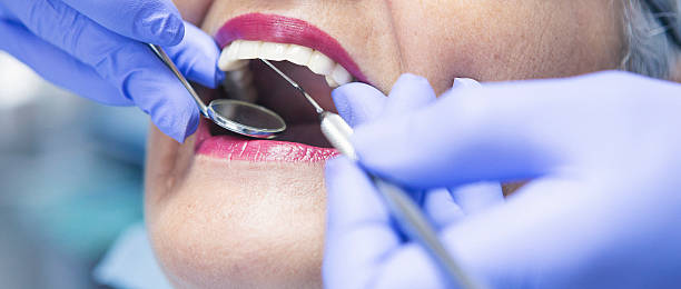 Best Knocked-Out Tooth (Avulsed Tooth) Treatment in Harrison, OH